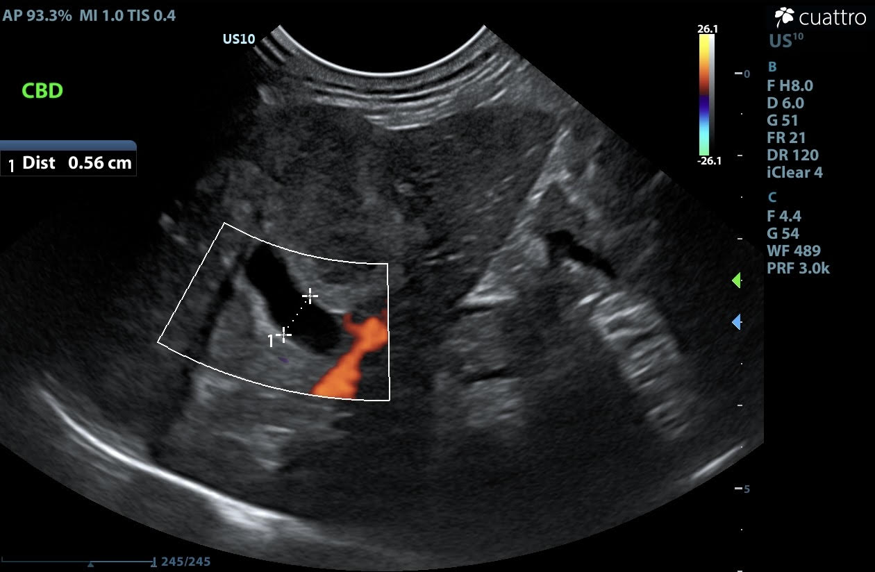 This structure is the dilated common bile duct