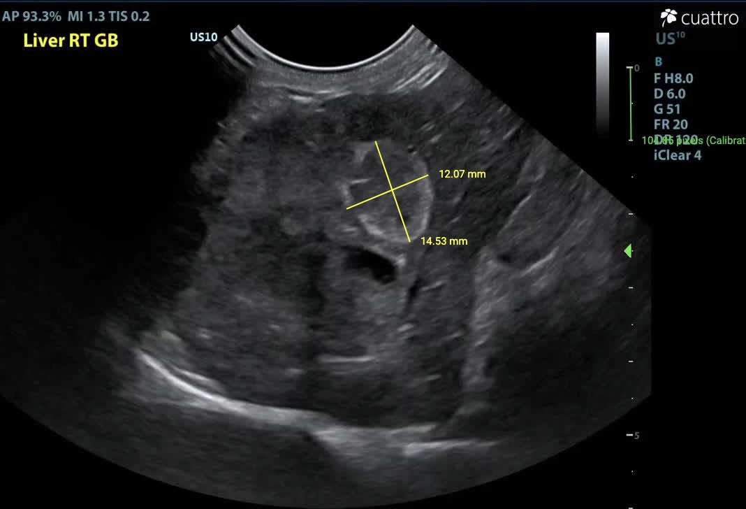 Infl amed gallbladder v. second coalescing mass.