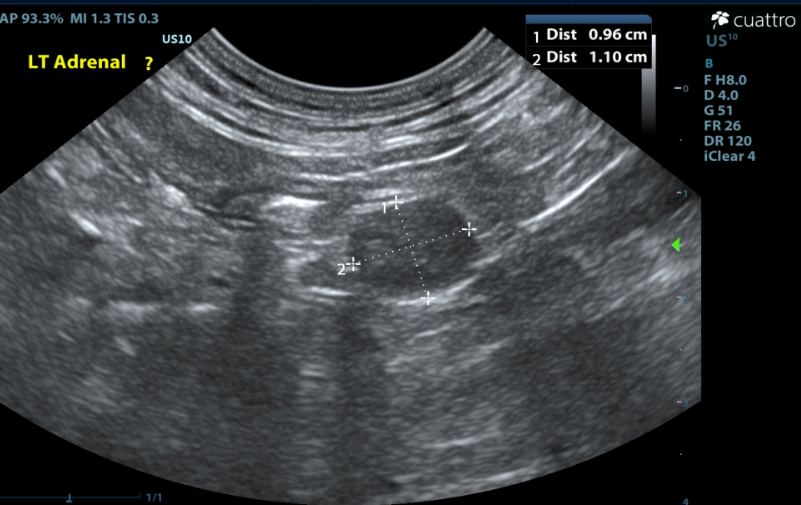 Left Adrenal