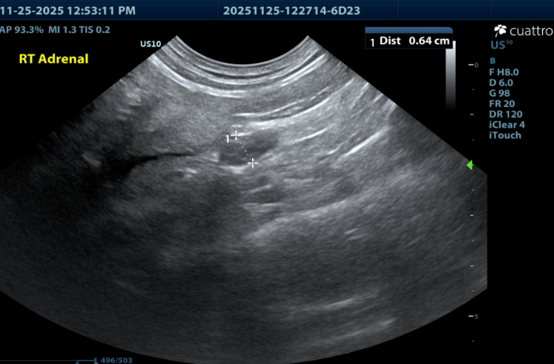 Adrenal Glands