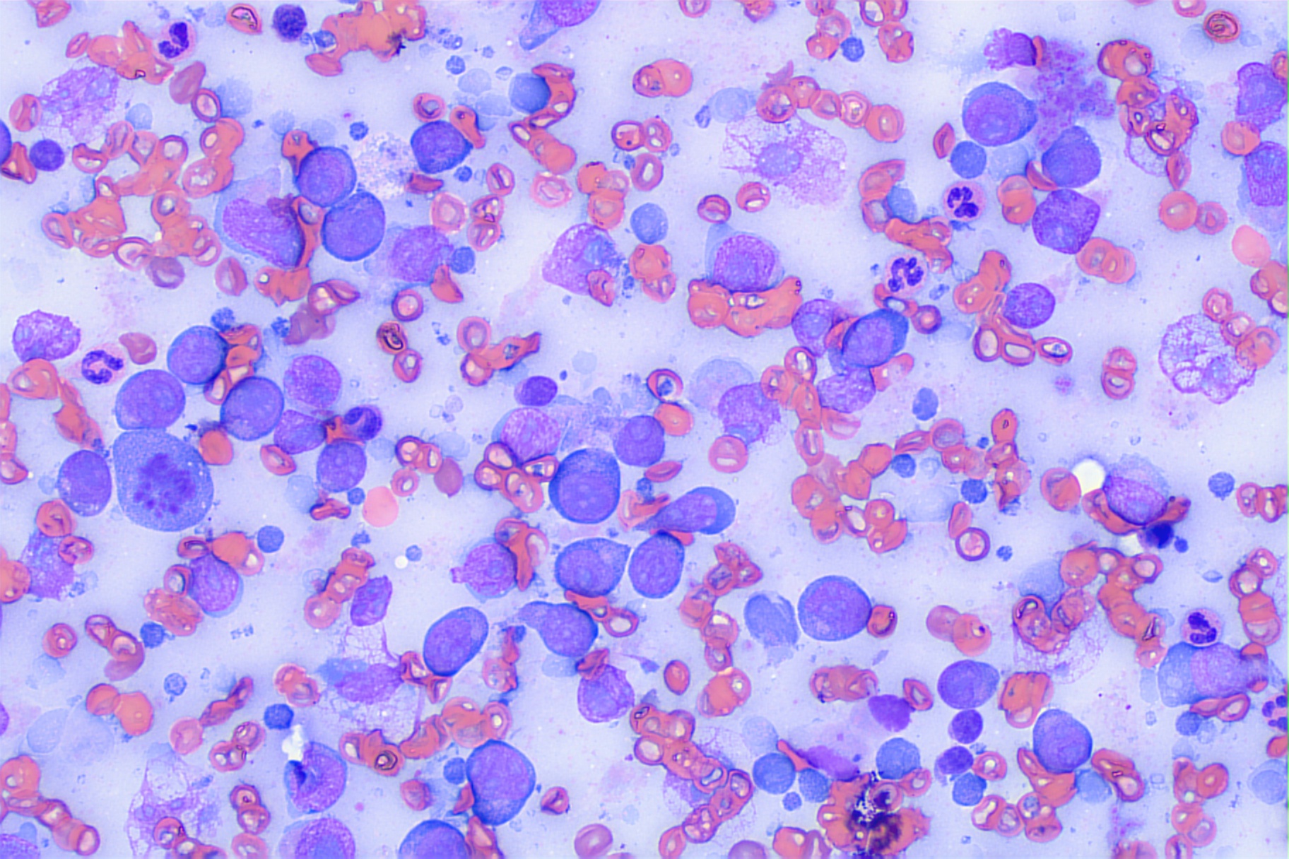 biopsy