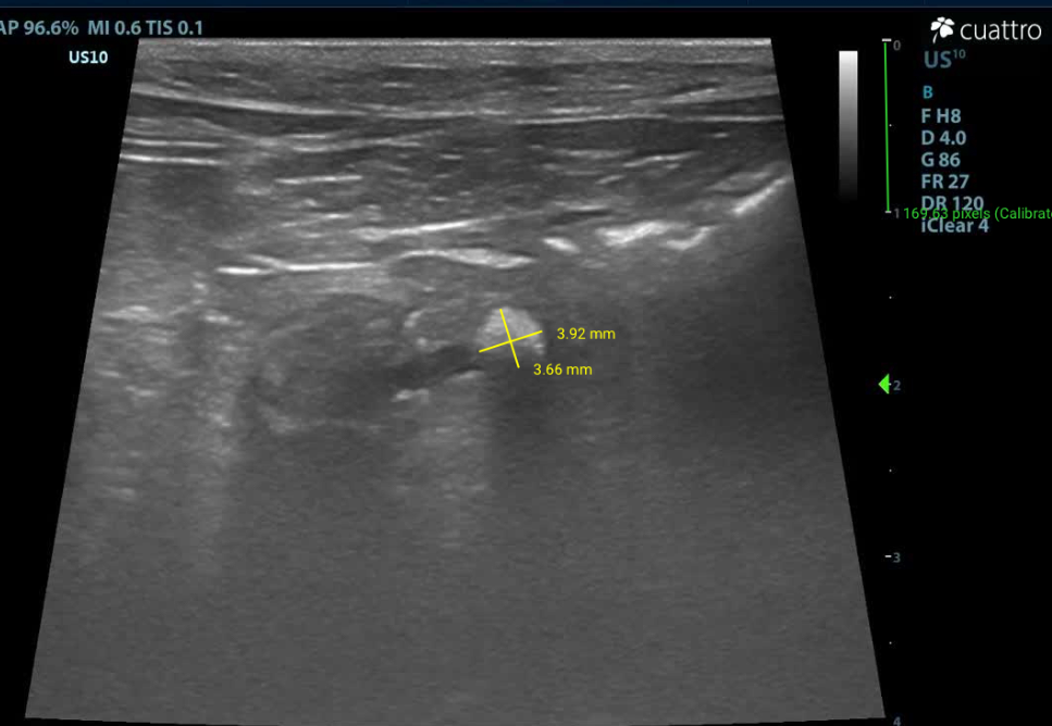 Pancreatolith in right limb of pancreas