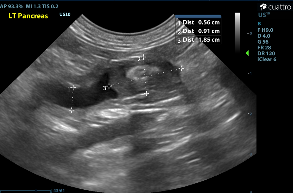 Pictured above is dilated pancreatic duct in the left limb of the pancreas with a mixed echogencity structure noted in the distal limb.  