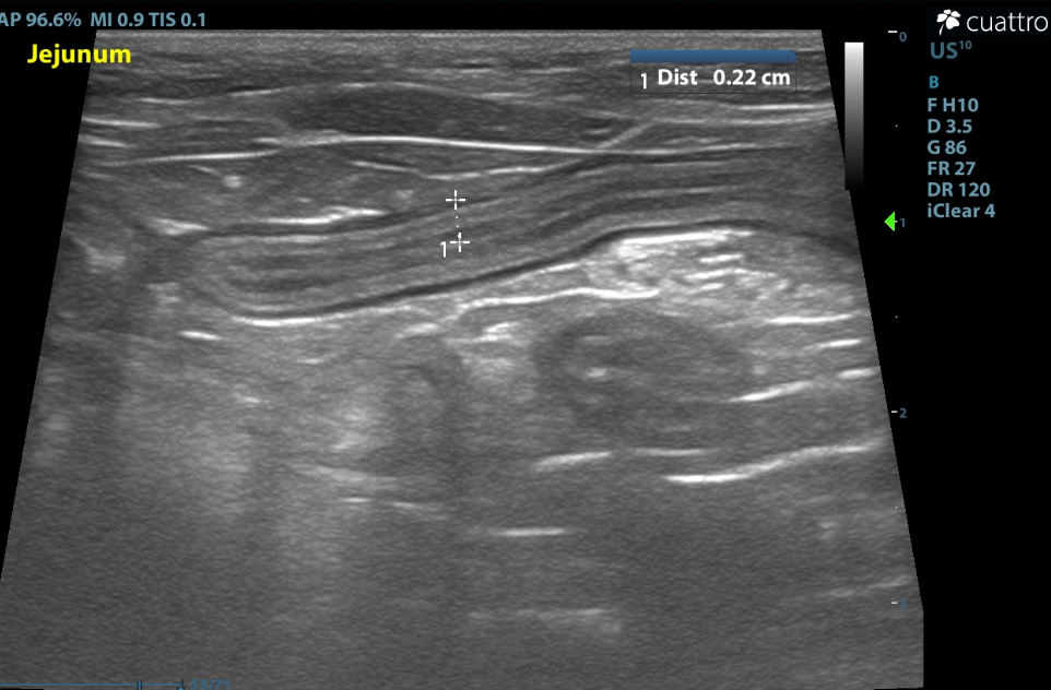 Pictured above is submucosal splitting noted in jejunum