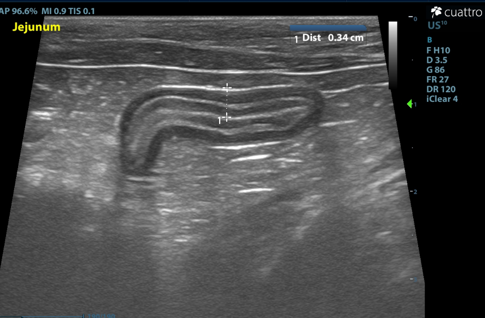 Pictured above is a moderately thickened loop of jejunum with prominent muscularis layer