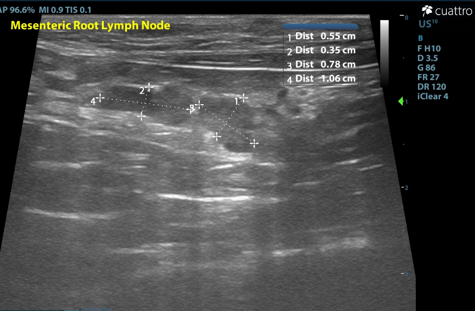 Pictured above are mildly prominent hypoechoic mesenteric lymph nodes