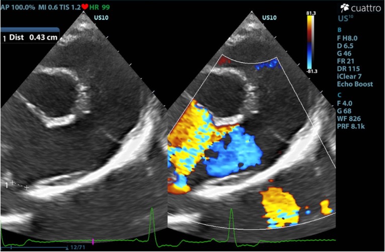 parasternal short axis heart base view