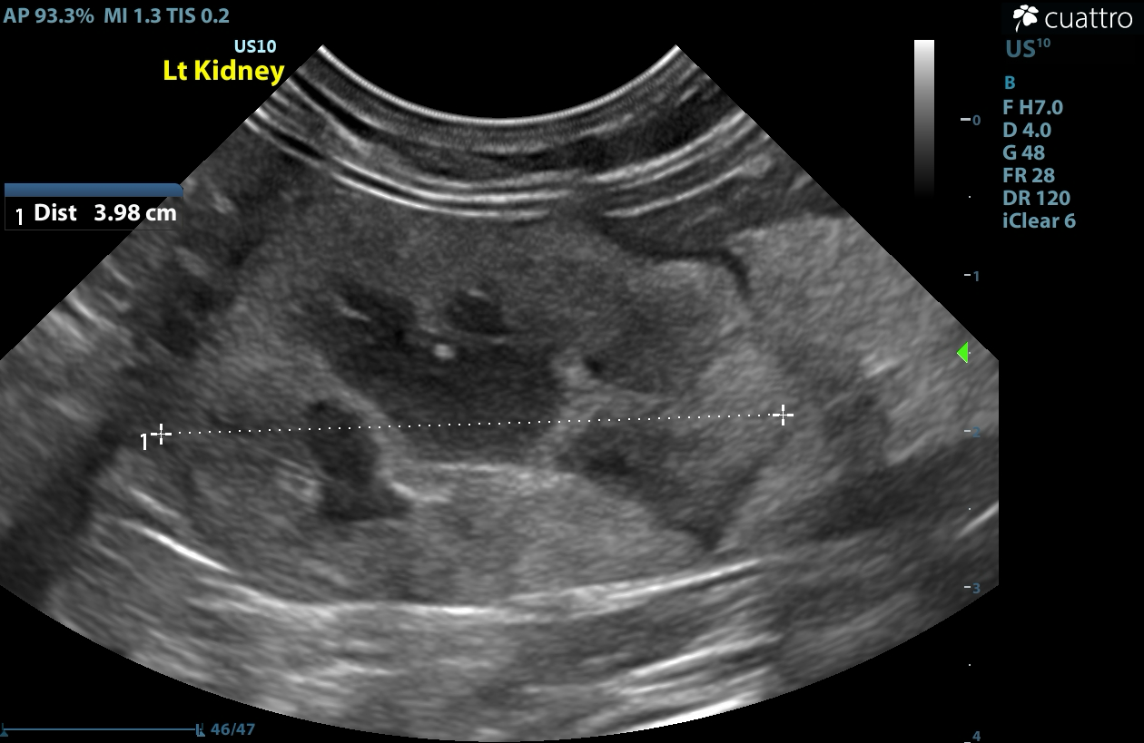 7/6/26-Left Kidney 2 month post treatment.  