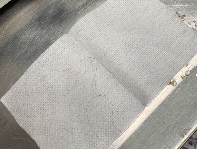 Strand of hair found causing intestinal plication